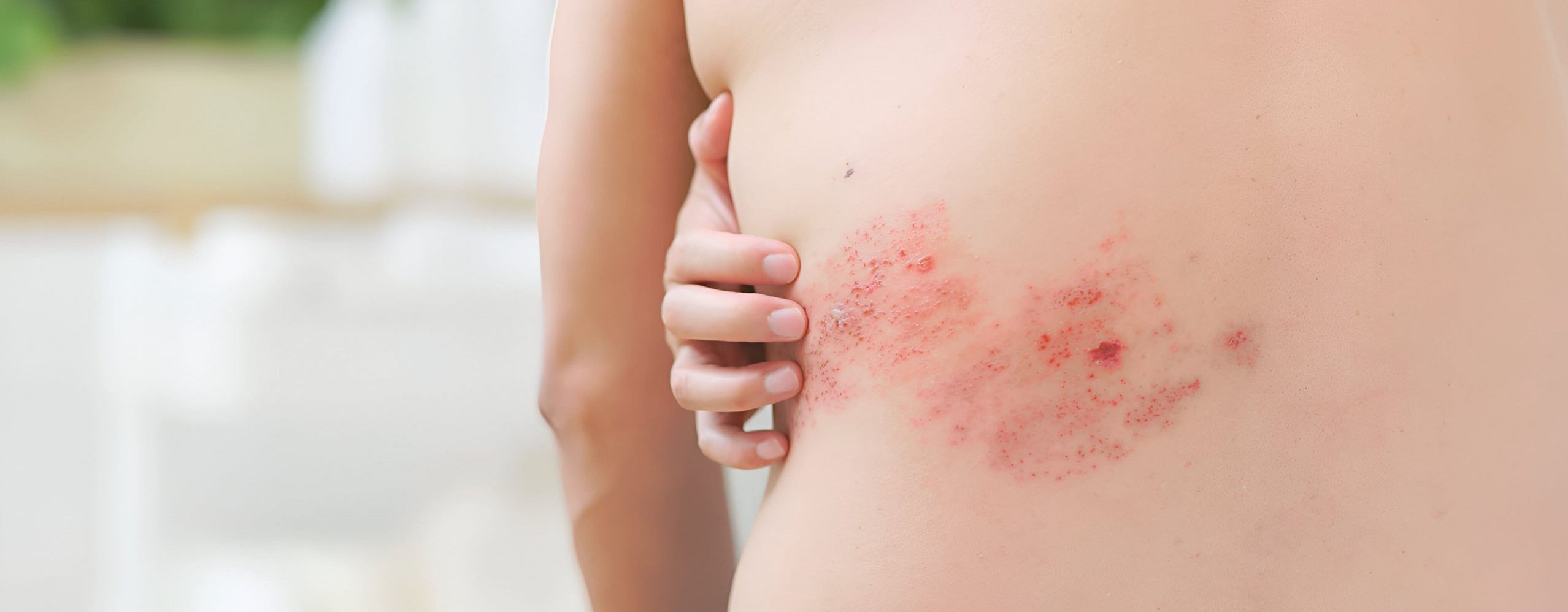 대상포진 발진 - 옆구리 통증 부위, 발진 사라진 후에도 신경통 지속되는 대상포진 후 신경통이미지