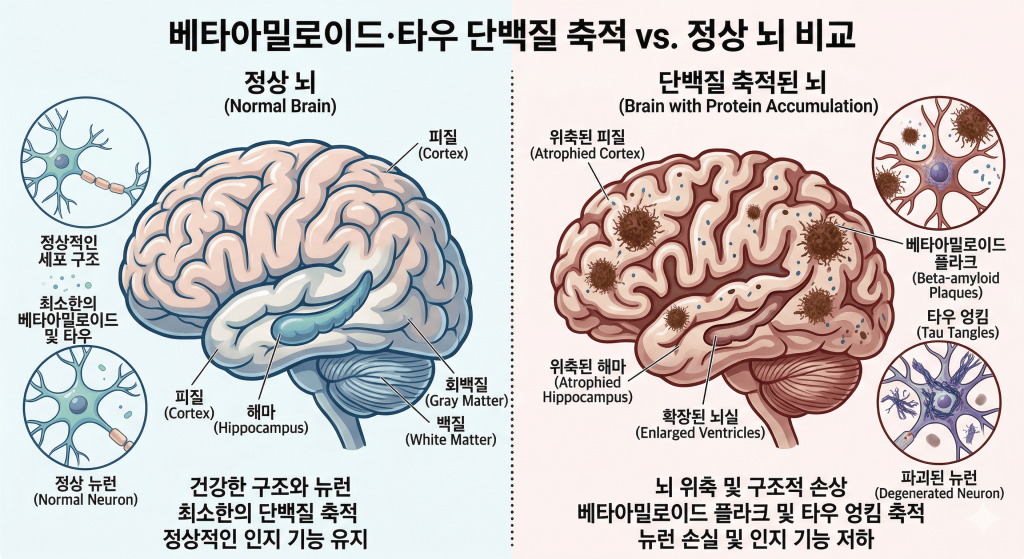 베타아밀로이드·타우 단백질 축적 vs. 정상 뇌 비교 alt text: 정상 뇌와 알츠하이머 치매 관련 단백질 축적 뇌의 비교 인포그래픽. 왼쪽 정상 뇌는 건강한 피질·해마·뉴런 구조를 보여주며, 오른쪽은 베타아밀로이드 플라크·타우 엉킴·위축된 해마·확장된 뇌실 등 구조적 손상을 시각화했다.