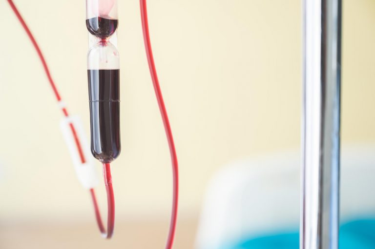 자외선 혈액치료에 사용되는 혈액 채취 튜브와 수혈 라인 클로즈업 English alt: Close-up of blood collection tube and transfusion line used in ultraviolet blood irradiation therapy